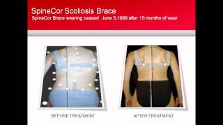 SpineCor Scoliosis Brace Patient Case Study [upl. by Ataeb]