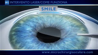 Intervento Laser Occhi Come Funziona [upl. by Freudberg788]