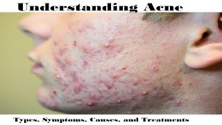 Understanding Acne Types Symptoms Causes and Treatments [upl. by Neyuq]