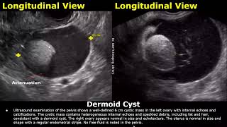 Ovary Ultrasound Reporting  Ovarian Diseases Scan Reports  How To Write USG Report  Pelvic USG [upl. by Teak]