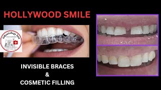 CLEAR ALIGNER amp COSMETIC FILLING FOR HOLLYWOOD SMILE  ORTHODONTICS amp RESTORATIVE SMILE DESIGNING [upl. by Ennylyak143]