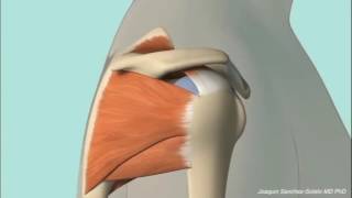 Chronic Subacromial Impingement Animation [upl. by Anni56]