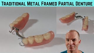 Close up look at a traditional metal framed partial denture [upl. by Kappel]