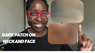 Acanthosis Nigricans The Skin Condition That Warns You About Diabetes [upl. by Intruok]