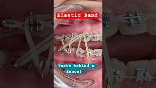 Elastic Band Orthodontic Braces [upl. by Acirre126]