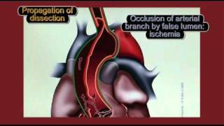 Physiopathology of aortic dissection [upl. by Nichani]