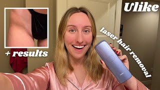 Ulike LASER HAIR REMOVAL Review unboxing and 3 weeks using it [upl. by Dallas371]