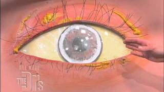 Cholesterol Deposits in the Eye The Doctors [upl. by Austin]