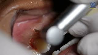 Doctor Smile Pluser Erbium Laser  Gum Depigmentation  Dr Maraoui [upl. by Edra]