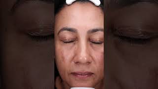 A demonstration of the mesoestetic® mesopeel® melanostop tran3x with Luxe Skin Aesthetics UnboxMe [upl. by Ahsela457]