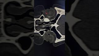 Dacryocystitis Due to Nasolacrimal Duct Blockage in EYECTDCG SCAN CTSCAN CTORBIT skullbase [upl. by Raphael]