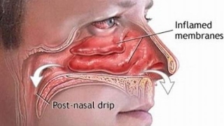 How to Cure Postnasal Drip Removing Allergens from Your Environment and Using Unverified Natural [upl. by Stevana]