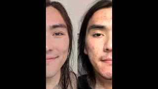 Accutane Transformation Timelapse shorts [upl. by Aseeral689]