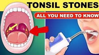 Natural Remedies to get rid of Tonsil stonestonsilitis tonsilstone [upl. by Niven]