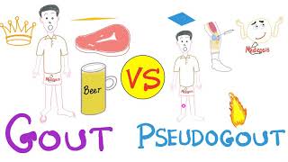 Gout vs Pseudogout  MSU vs CPPD disease  Rheumatology Series [upl. by Longwood]