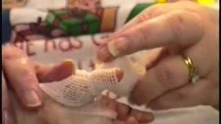 ABCs Hand Wrapping Technique Epidermolysis Bullosa [upl. by Hawkie]