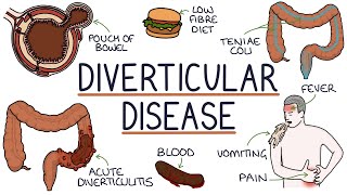 Understanding Diverticulosis and Diverticulitis [upl. by Siskind]