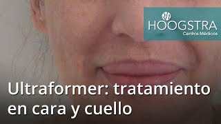 Tratamiento Ultraformer en cara y cuello 17066 [upl. by Relyuc]