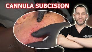 RIP APART ACNE SCARS WITH A CANNULA SUBCISION  Dr Jason Emer [upl. by Hadnama]