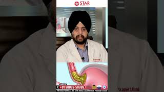 Diffrence Between Hiatus HerniaGERDAcid Reflux in Hindi Hme inme Se Kya Huya Hai kese pta kre [upl. by Aulea]