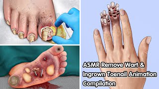 ASMR Remove Wart amp Ingrown Toenail Animation Compilation  Deep Cleaning Animation [upl. by Werby]