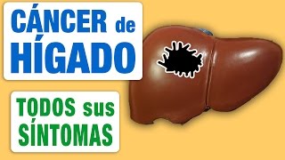 Todos los Síntomas del Cáncer de Hígado [upl. by Suillenroc]