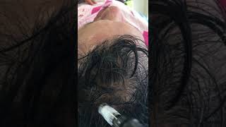 Tratamiento para la calvicie  Alopecia Cali Colombia  Parte 1 [upl. by Crowns117]