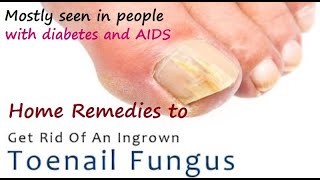 Home Remedies for Ingrown Toenail I How to Treat an Ingrown Toenail I How to Get Rid of Ingrown Toe [upl. by Clay701]