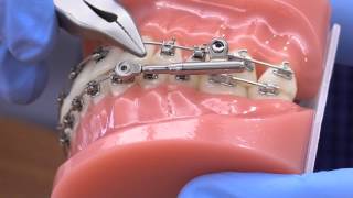 American Orthodontics PowerScope Activation [upl. by Adnarram103]