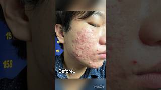 Severe acne before and after isotretinoin 1 year treatment acne isotretinoin jerawat acnescars [upl. by Anerb651]