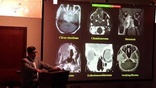 Aneurysmal bone cyst in skull base ABC 33 [upl. by Nairrod881]