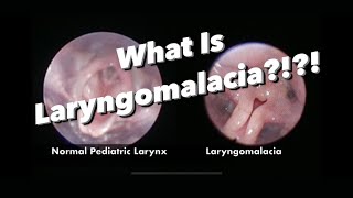 Laryngomalacia  What is it what are the symptoms how is it managed [upl. by Kathe281]