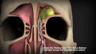 Balloon Sinuplasty Frontal Sinus [upl. by Nagaek161]