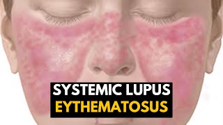 Systemic Lupus Eythematosus SLE Causes Signs and Symptoms Diagnosis and Treatment [upl. by Evelc]