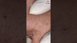 Customers squeeze acne at GaSpa Clinic gaspa phongkhamdalieu acne shortsvideo [upl. by Nira]