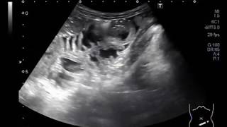 Ultrasound Video showing hepatomegaly and small bowl obstruction in a child aged 9 years [upl. by Agnesse]