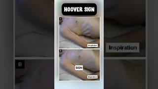 Hoover sign in copd usmle neetpg pulmonology [upl. by Ialohcin]