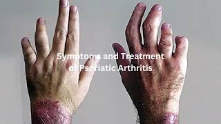 Symptoms and Treatment of Psoriatic Arthritis [upl. by Refotsirhc]