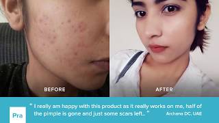 PRAVENTAC™ Acne Pills Review 4  Results  Customer Before amp After [upl. by Oiluig839]