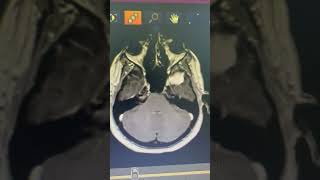 meningioma resection [upl. by Kcirderf62]