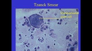 Tzanck smear Positive [upl. by Raffaj]