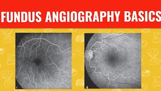 FFA course  FUNDUS FLUORESCEIN ANGIOGRAPHY [upl. by Nylrehc266]