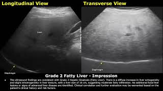 Grade 2 Fatty Liver Ultrasound Report Example  Diffuse Hepatic Steatosis Sonography  Abdominal USG [upl. by Jackie]