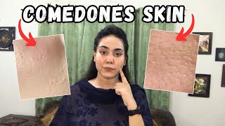 Comedones Skin Treatment  Shamaim Rajpoot [upl. by Sparrow]