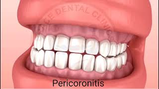 What is Pericoronitis When is Operculectomy Brace Dental Clinics [upl. by Mima]