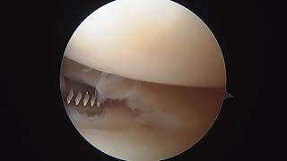 L knee partial bilateral menisectomy and chondroplasty 21020 WM [upl. by Broome]