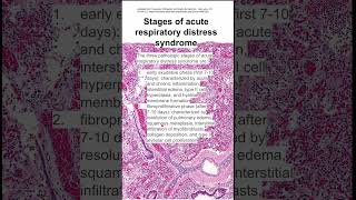 Stages of acute respiratory distress syndrome [upl. by Nwotna]