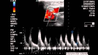 Duplex Exam of Moderate ICA Stenosis  Case Study [upl. by Skeie716]