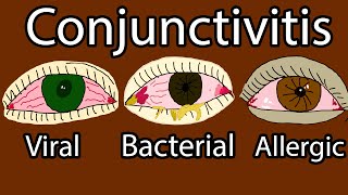 Pink Eye Conjunctivitis  Viral Bacterial and allergic conjunctivitis Symptoms and treatment [upl. by Syman]