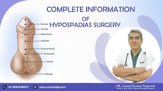 Hypospadias Surgery  Complete Information of Hypospadias Problem amp Solution  By Dr A K Nagwani [upl. by Lydia]